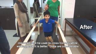 Spastic Quadriplegic Cerebral Palsy Treatment Result [upl. by Saxe]