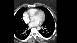 Pulmonary Embolism CT Discussed by Radiologist [upl. by Rancell443]