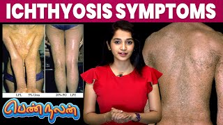 Ichthyosis நோய்யின் Symptoms இது தான்  Remedies For Ichthyosis  Pen Nalan  IBC Mangai [upl. by Lahey]