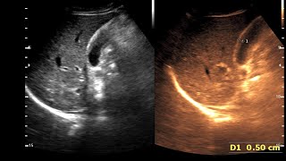 Adenomyomatosis Gall Bladder  RokitanskyAschoff sinuses [upl. by Artek]