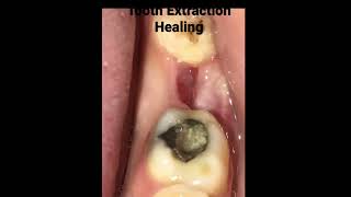 Tooth extraction healing Timelapse [upl. by Mays]