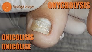 Onycholysis due to trauma podology asmr [upl. by Asille31]