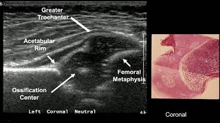 What is Hip Dysplasia [upl. by Nageam]