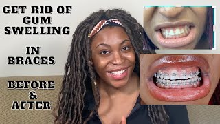 How to get rid of Gum swelling in braces [upl. by Arthur]