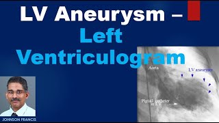 LV Aneurysm – Left Ventriculogram [upl. by Tor]