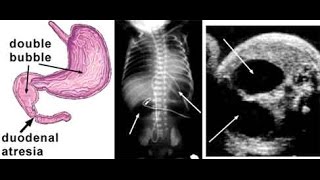 Duodenal Atresia [upl. by Seavir]