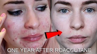 ONE YEAR AFTER ROACCUTANE  MY SKIN NOW [upl. by Kelcie178]