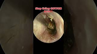 Deep Impacted Cerumen With Severely Swollen Ear Canal [upl. by Ellehcan]