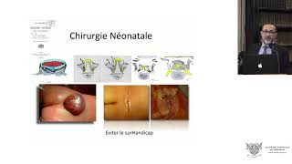 Le traitement chirurgical prénatal endoscopique du myéloméningocèle [upl. by Ladin199]