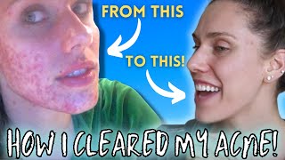 HOW I CLEARED MY ACNE  Chronic Cystic Digestive Hormonal [upl. by Stargell]