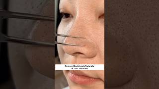 Get Rid Of Blackheads  Remove Blackheads Naturally In 2minutes blackheads skincare shorts viral [upl. by Azil707]