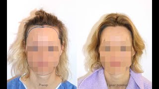 Hair Transplant WomenFemale Before and After  Receding Hairline  High Forehead  Dr Feriduni [upl. by Akli185]