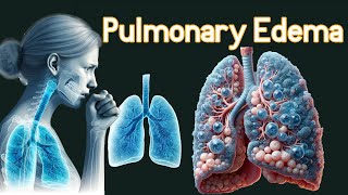 Pulmonary Edema Fluid In the Lungs Symptoms amp causes [upl. by Nylarac]