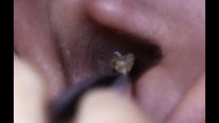 ASMR ear cleaning แคะหูน้องยิ่งใหญ่ 24 [upl. by Karr388]