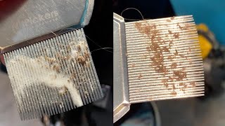 CloseUp Of Lice Infestation Removal [upl. by Rotceh]