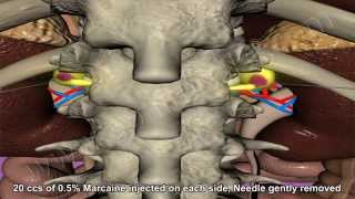 Celiac Plexus Block [upl. by Naujed644]