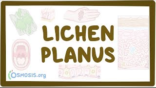 Lichen planus treatment  Hindi [upl. by Shaff602]