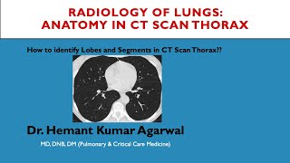 Radiology CT Thorax Lungs Anatomy How to Identify Lobes and Bronchopulmonary Segments in CT Thorax [upl. by Malia792]