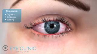 Dry Eye Meibomian Gland Dysfunction amp LipiFlow Dry Eye Treatment [upl. by Barcot]