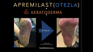 Apremilast Otezla and Keratoderma [upl. by Sholeen]