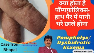 What is pompholyx or Dyshidrotic Eczema Real Time cured case study [upl. by Licht366]