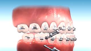 How to correct Class III Malocclusion [upl. by Chantalle]