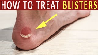 How to Treat Blisters  Home remedies of blister treatment and heal [upl. by Hulburt]