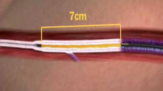 The VNUS Closure Procedure Using ClosureFAST Catheter [upl. by Leeth739]