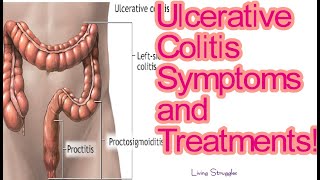 Ulcerative Colitis Symptoms and Treatments [upl. by Helaine]