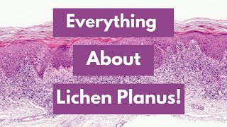 Oral Lichen Planus Introduction Etiology Clinical Features Diagnosis Management [upl. by Niltiac]