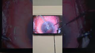 how to break cataract in phaco surgery  ছানি অপারেশন [upl. by Nuhs]