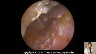 Top Biggest Ear Wax Removal 108  Ear wax Extraction  Dr S Thouk Earwax Specialist [upl. by Alene180]