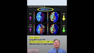 CT Perfusion Core Infarct amp Ischemic Penumbra Findings CTA amp CTP Neuroimaging in Stroke Patients 26 [upl. by Agate142]