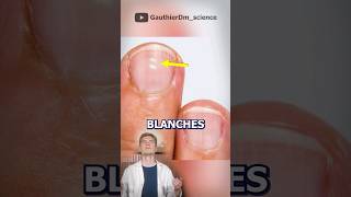 LES PETITS POINTS BLANCS SUR LES ONGLES  science santé apprendre education corpshumain [upl. by Eldora]