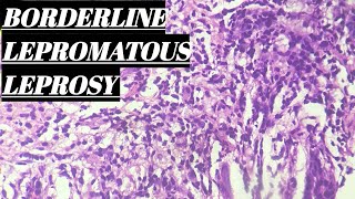 Borderline Lepromatous Leprosy Histopathology [upl. by Mines]