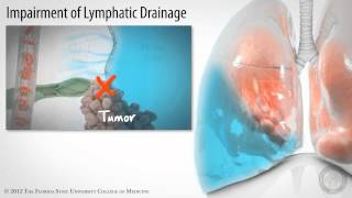 Pleural Space Part 3 of 3 Pleural Effusions HD [upl. by Yemorej]