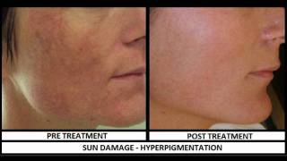 NonSurgical amp NonInvasive Laser Treatment in Dubai  Dubai Cosmetic Surgery [upl. by Weeks]