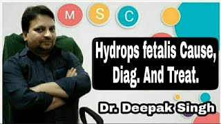 Hydrops fetalis Cause Diag And Treat  Fetal Oedema  Fetal Hemolytic Disorder  Deepak PD Singh [upl. by Araec]