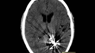 CT Head AVM  Anatomy DISCUSSION by Radiologist [upl. by Vada]