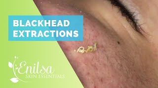 Blackhead Extractions on “K” 9 [upl. by Meekahs337]