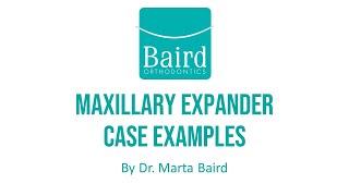 Orthodontic Maxillary Expander Patient Case Examples at Baird Orthodontics [upl. by Anthe]