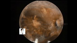 Review of cholesteatoma and ear wax removal9mins20221103 [upl. by Ojillek]