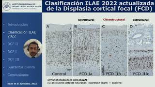 8 Neuropatología de las Displasias corticales Dr Jesús Cienfuegos Meza [upl. by Rinaldo]