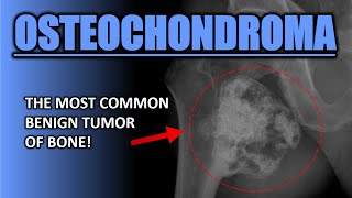 Osteochondroma bones radiology medical [upl. by Asel]