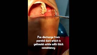 pus discharge from parotid duct parotidduct pusdischarge nonspecific dentist [upl. by Nnaeirelav]