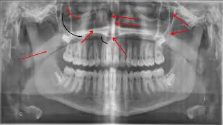 apprendre à lire une radio panoramique dentaire dentist dental dentista dentistry santé [upl. by Nylinnej488]