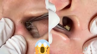 Ultimate Blackhead Removal Techniques Satisfying Pimple Pops amp Pore Strip Extractions [upl. by Aiam]