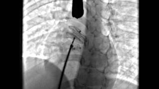 Septal Occluder release across the ASD [upl. by Anoel956]