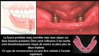 Prothèse amovible et implants dentairesMandibular overdentures [upl. by Sigvard581]