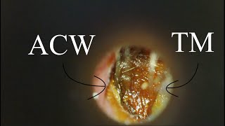 DEEP IMPACTION  ANTERIOR SULCUS  4KHD [upl. by Simetra]